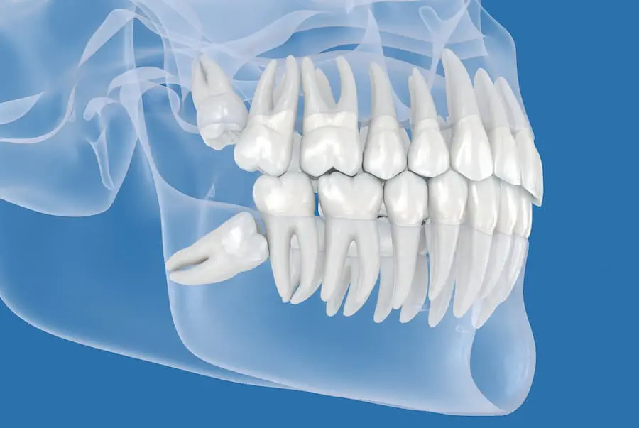 Wisdom Teeth Removal | Alliance Oral & Maxillofacial Surgery